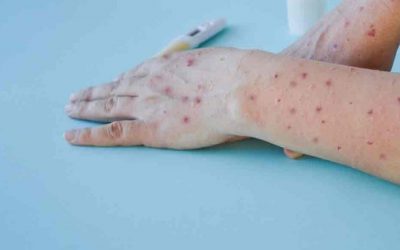 Gripe del tomate, la nueva enfermedad que enciende alarmas en el mundo: cómo detectarla