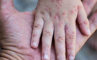 Brote de sarampión en EE.UU.: muere otro menor sin vacunar en Texas y siguen aumentando los casos